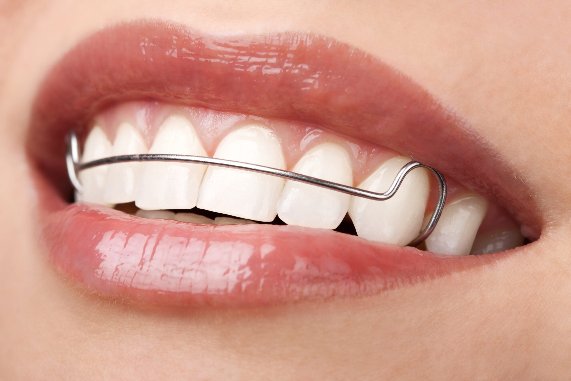 After getting your braces off, you may wonder, "Why do I need to wear a retainer?" Smiles from the Hart is here to explain why you should!