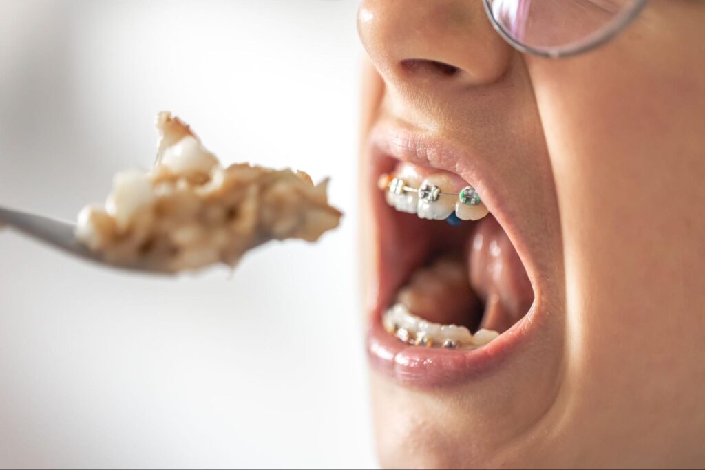 How To Care for Your Braces In Between Appointments